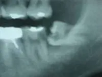 抜いた方が良い親知らず01