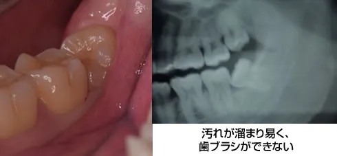 親知らず症例