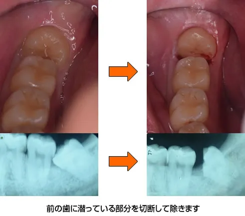 親知らず症例