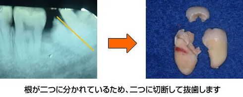 親知らず症例