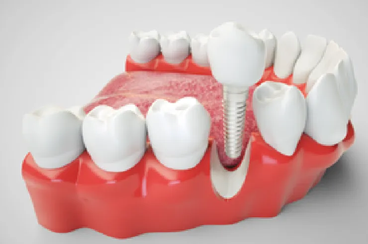 インプラント治療について