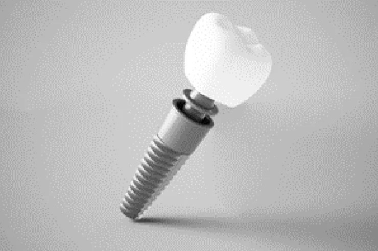 歯科におけるインプラントとは?