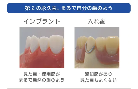 インプラントと「入れ歯」の違い